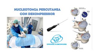 Discectomia Percutanea en la Hernia de Disco [upl. by Stilu]