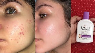 Lacto Calamine Lotion ReviewBenefits side Effects Price  Chehre saaf karne wala cream 😍 [upl. by Yoccm]