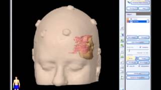 Removal of Brain Tumor Meningioma brain surgery [upl. by Adnauq]