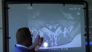 Low Back Pain MRI Showing Disuse Muscle Atrophy  Vancouver Wa [upl. by Bo]