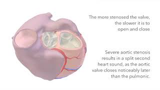 Aortic Stenosis  Murmur Sound amp Animation [upl. by Okimuk]