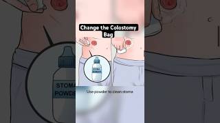 Colostomy care and change colostomy bag procedure steps  nursingofficer norcet aiims nursing [upl. by Aihsoek]