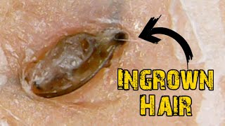 Ingrown Hair Removal x Satisfying Blackheads [upl. by Kenlay]