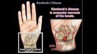 Kienbocks Disease  Everything You Need To Know  Dr Nabil Ebraheim [upl. by Hefter166]