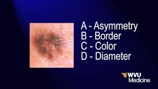 Moles and Skin Cancer  WVU Medicine Health Report [upl. by Dorahs]