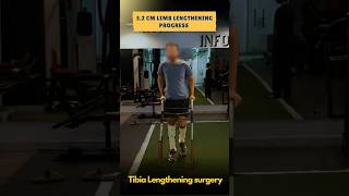 52 cm limb lengthening progress  Tibia lengthening surgery [upl. by Shargel]