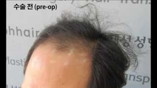 FUSS 4700 hairs transplantation [upl. by Nepil]