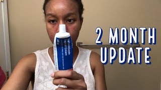 2 month Update Review of Metronidazole Cream for my Perioral Dermatitis and Acne [upl. by Bratton]