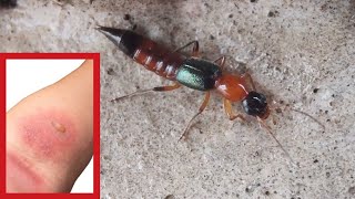 This Rove beetle is VERY DANGEROUS  Dont touch Toxic chemical [upl. by Elnar948]