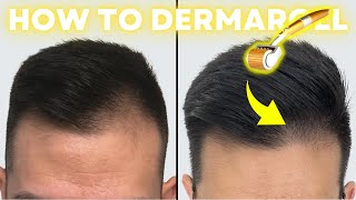 How to Derma Roll for Quickest Hair Results StepbyStep Guide [upl. by Anavlys]