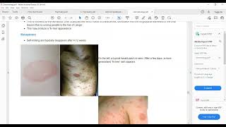 Plab 1 Lectures Dermatology Part 11 Acnae Rosacea Pityriasis Rosea Scabies [upl. by Notnilc524]