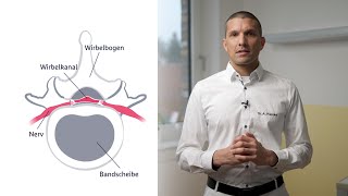 Behandlungsmöglichkeiten der Spinalkanalstenose [upl. by Eirual]