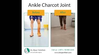 Ankle Charcot joint [upl. by Ecidnak]