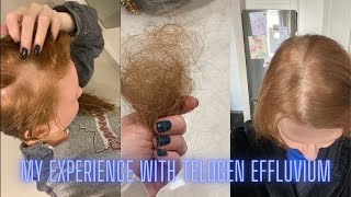 My Experience with Telogen Effluvium [upl. by Vernita]