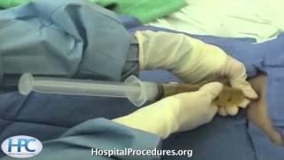 Paracentesis Procedure Video Trailer [upl. by Emmott]