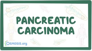 Pancreatic carcinoma  an Osmosis Preview [upl. by Tymothy987]