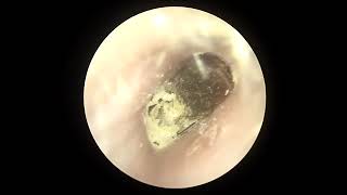 귀지 제거 및 귀에 빠진 면봉 제거 removal of impacted cerumen amp foreign body [upl. by Gearalt3]