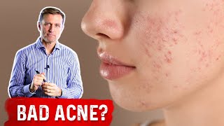 If Nothing is Working for Acne Try This Acne Removal Treatment – DrBerg [upl. by Deering]