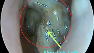 Most unexpected object extracted from nostril  Left nostril rhinolith  neglected chicken bone [upl. by Dimphia]