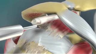 Animation of OrthoSpace Balloon for massive rotator cuff tear [upl. by Nodnnarb]