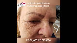 Harmonização facial com jato de plasma [upl. by Eeluj]