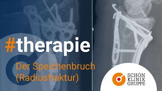 Der Speichenbruch Radiusfraktur  Schön Klinik München Harlaching [upl. by Anilemrac]