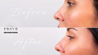 Plasma Fibroblast  Prive Academy  Nose Contouring Technique [upl. by Ozne]