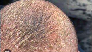 How to get rid of cradle cap in babieswhat is cradle cap [upl. by Apthorp]