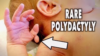 RARE POLYDACTYLY newborn  Dr Paul [upl. by Verity562]