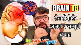 Brain TB symptoms in hindi  Tubercular meningitis  TB meningitis treatment in india [upl. by Notniuqal473]