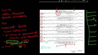 Pathophysiology of Seizures [upl. by Salisbury]