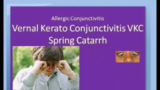 Ophthalmology 088 a Vernal KeratoConjunctivitis VKC Spring Catarrh Allergic Horner Tranta Eye [upl. by Huttan]