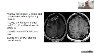 Multidisciplinary Care of Patients with Brain Metastases in the Era of Precision Medicine [upl. by Ydnac]