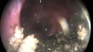 Nasal Myiasis  NEJM [upl. by Strohben]