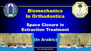 Space closure in Extraction Therapy In Arabic [upl. by Zulaledairam290]