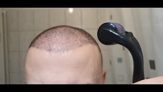 Minoxidil amp Dermarolling Results 6 MONTHS  Month by Month Progress [upl. by Hecker]