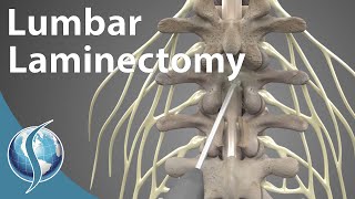 Lumbar Laminectomy [upl. by Naliorf837]