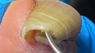 Extremely long ingrown toenailsThe patient has not had a pedicure for 4 months【Xue Yidao】 [upl. by Fellner]