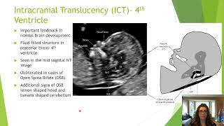 Beyond the ‘Nuchal’ Getting the Most from the 1114 Week Ultrasound  Michelle Sutherland  AFIC [upl. by Ellenoj199]