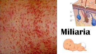 Miliaria Heat rash [upl. by Oliva]