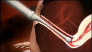 3D animation of how IVF works [upl. by Daley]