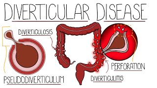 Understanding Diverticular Disease Diverticulosis and Diverticulitis [upl. by Irakuy]