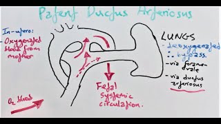 Patent Ductus Arteriosus presentation pathophysiology diagnosis amp treatment [upl. by Mulford518]