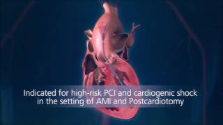 Impella® Heart Pump Animation For Physicians [upl. by Artemla]