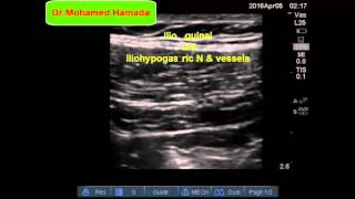 Ultrasound Guided IlioinguinalIliohypogastric Nerve Block [upl. by Amjan]