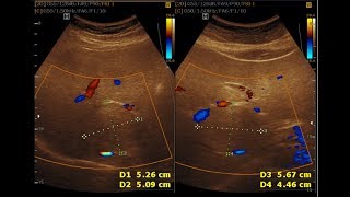 Ultrasound cases 494 of 2000  Hemangioma Grade 1 Fatty Liver [upl. by Elylrac285]