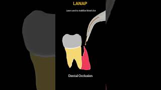 LANAP  Laser Assisted New Attachment Procedure Steps shorts dentist periodontology short [upl. by Initsed]