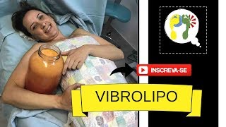 ADEUS BARRIGA VIBROLIPOASPIRAÇÃO PRÉ e PÓS CIRÚRGICO [upl. by Ijat]