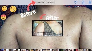 HOW TO GET RID OF SEVERE ACNE DARK SPOTS amp HYPERPIGMENTATION FAST  LIVE DEMO  NO CLICK BAIT [upl. by Alika]