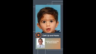 Cleft Palate Transformation Santiago [upl. by Llerryt593]